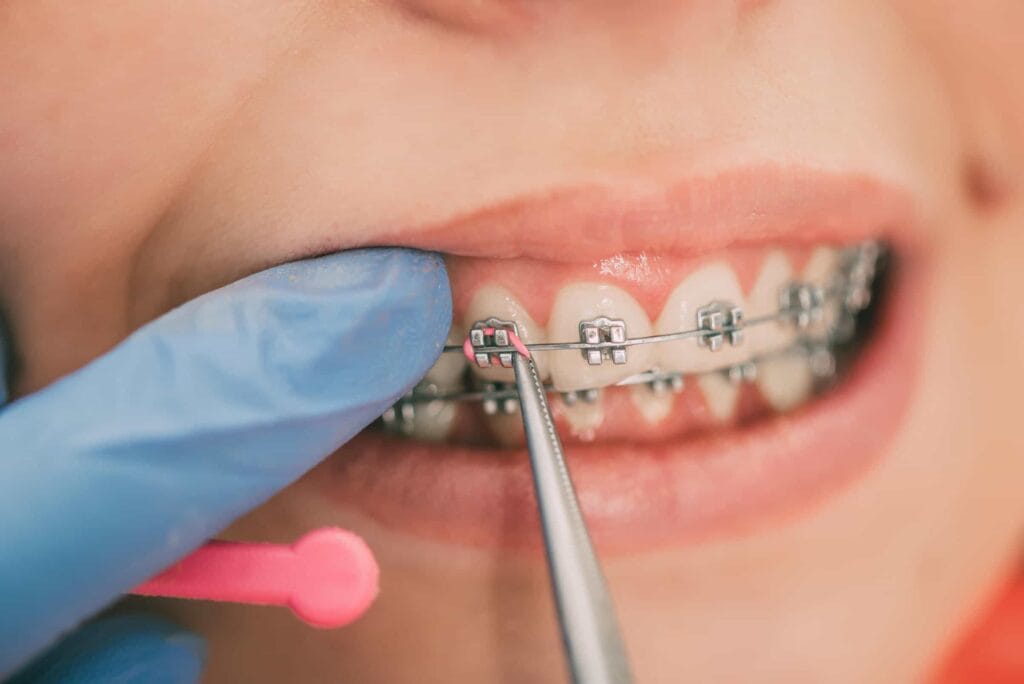 Braces Utc