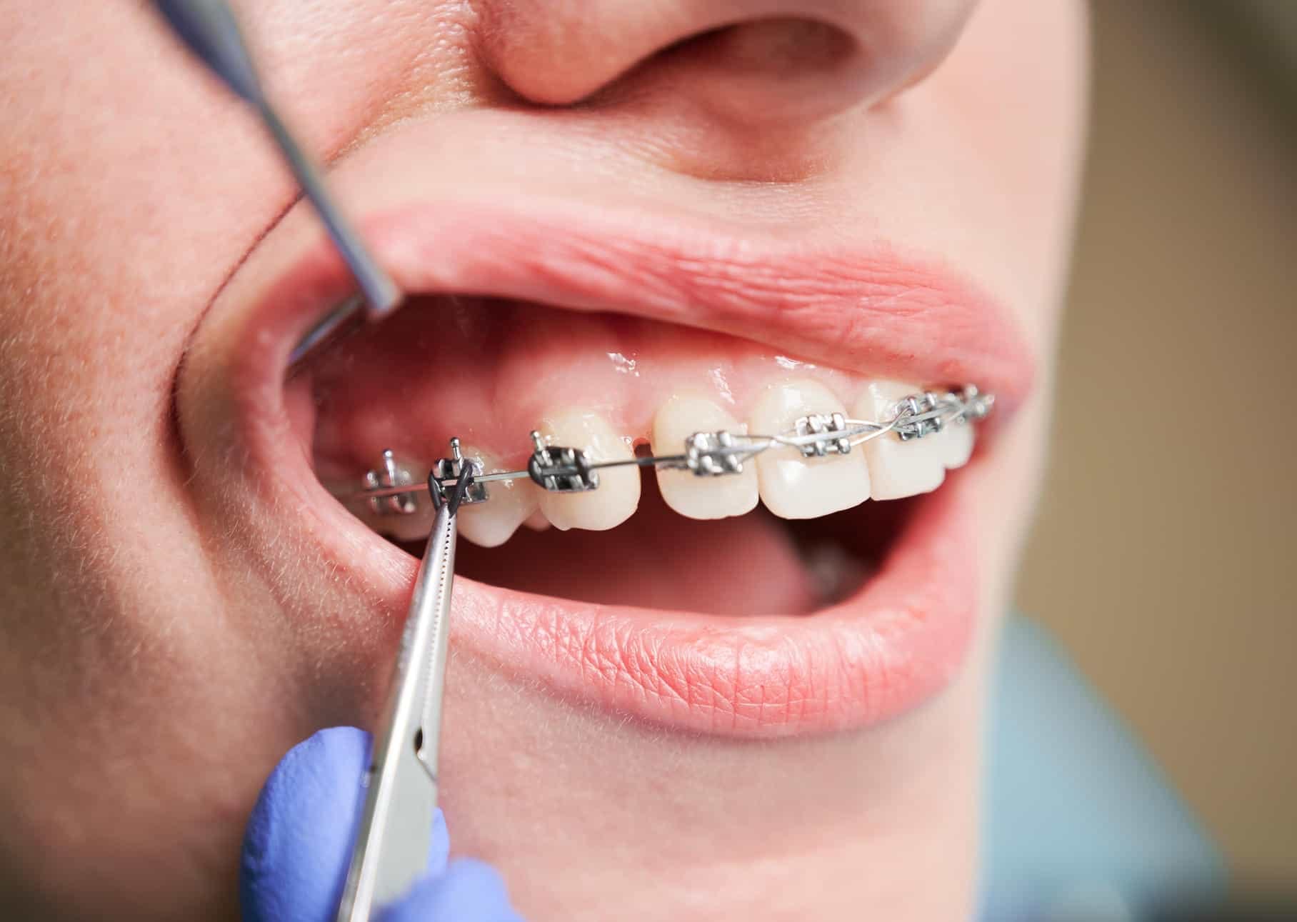 Dentist Placing Braces On Female Patient Teeth Utc